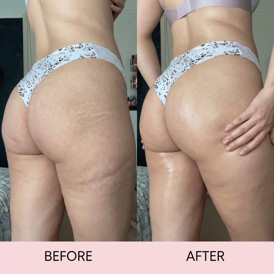 Anti-Cellulite Massage Oil for Firming and Smoothing Body Care