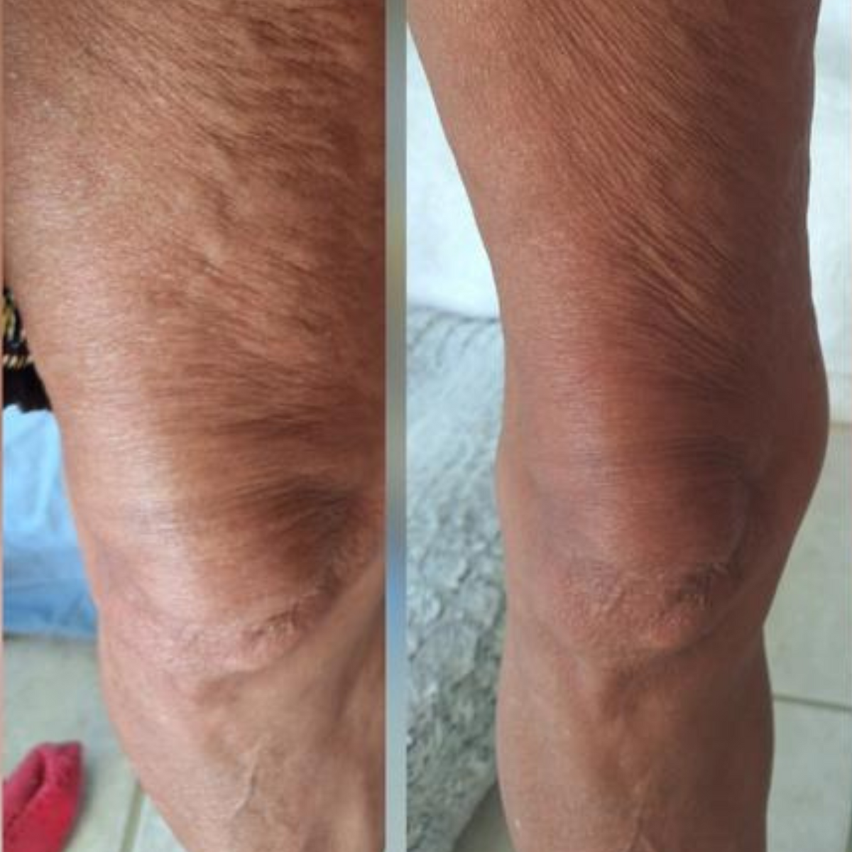 Anti-Cellulite Massage Oil for Firming and Smoothing Body Care